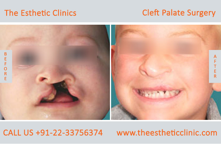 cleft palate surgery, Cleft Palate Repair Treatment before after photos in mumbai india (2)
